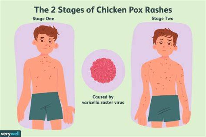 Can we eat egg in chicken pox