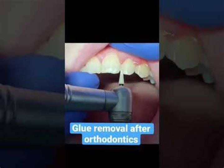 How to remove braces glue