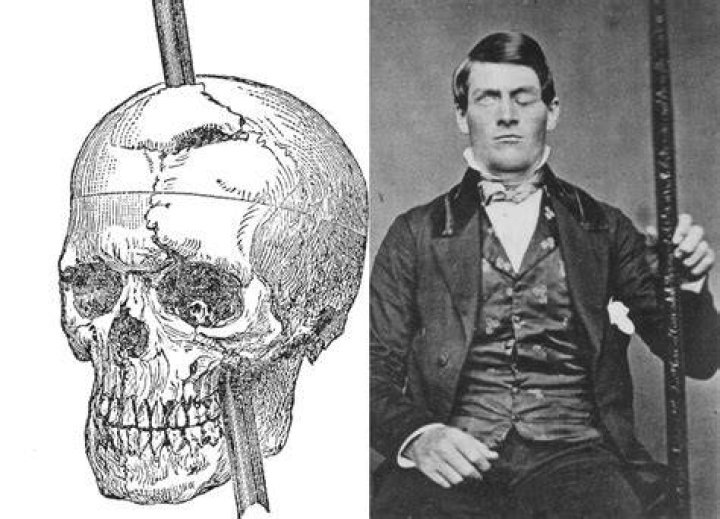 Phineas Gage Illustration