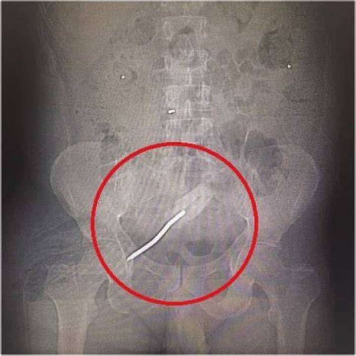 Screwdriver In Rectum